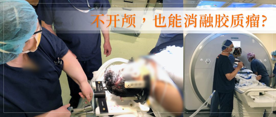 胶质瘤复发可以不开颅手术吗？国际儿童神外教授Rutka教授怎样答疑？