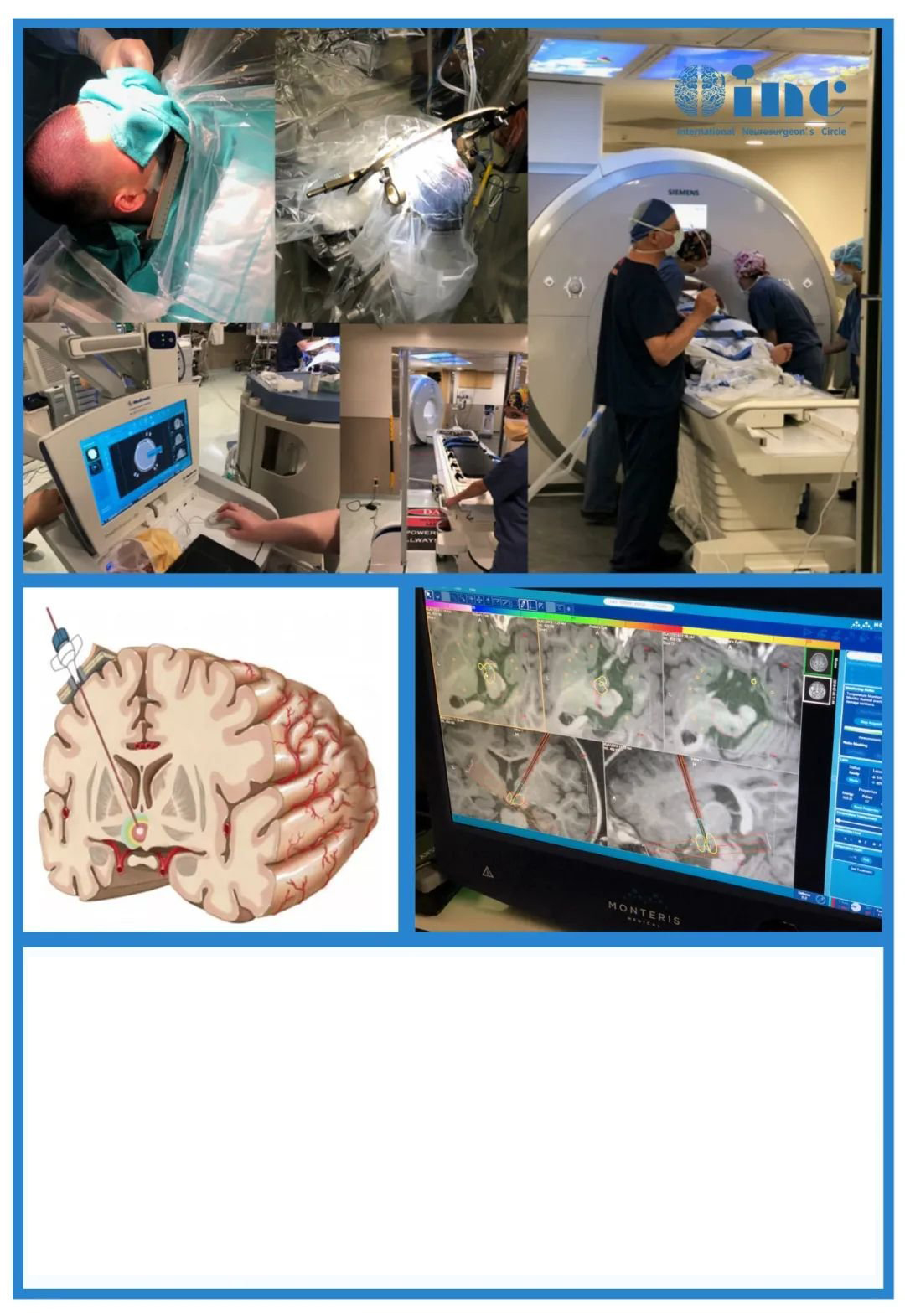 胶质瘤复发可以不开颅手术吗