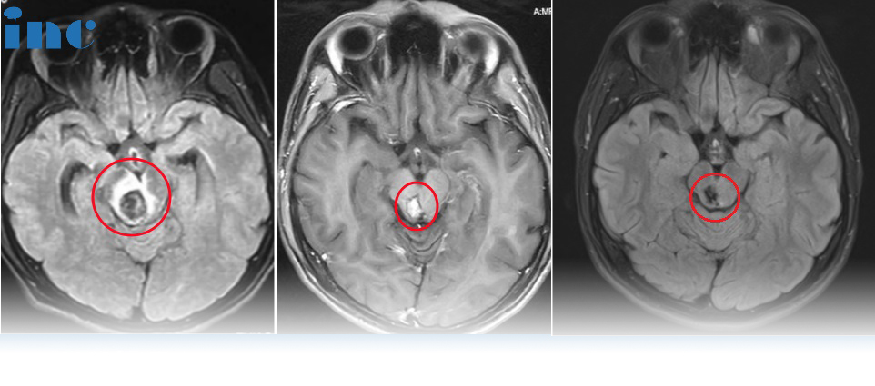 面瘫、话说不清、呛咳、走路不稳……巴教授脑干术后3个月，恢复如何？