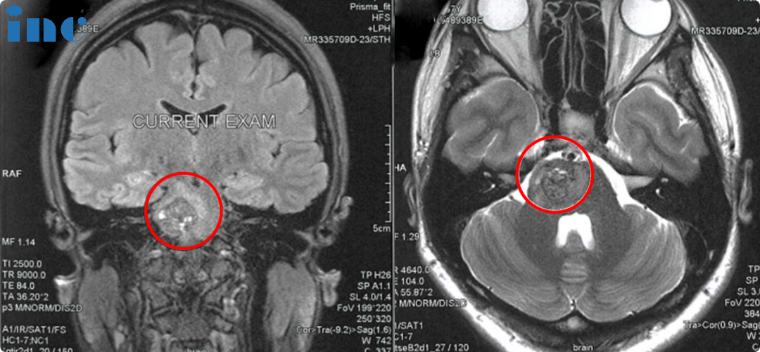 脑干海绵状血管瘤案例