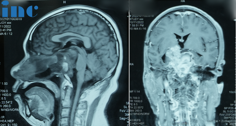 2023年1月底，患者四次出现之前的症状，4月份开始自感上下肢力量下降，患者可自行站立和行走，但自感不稳。