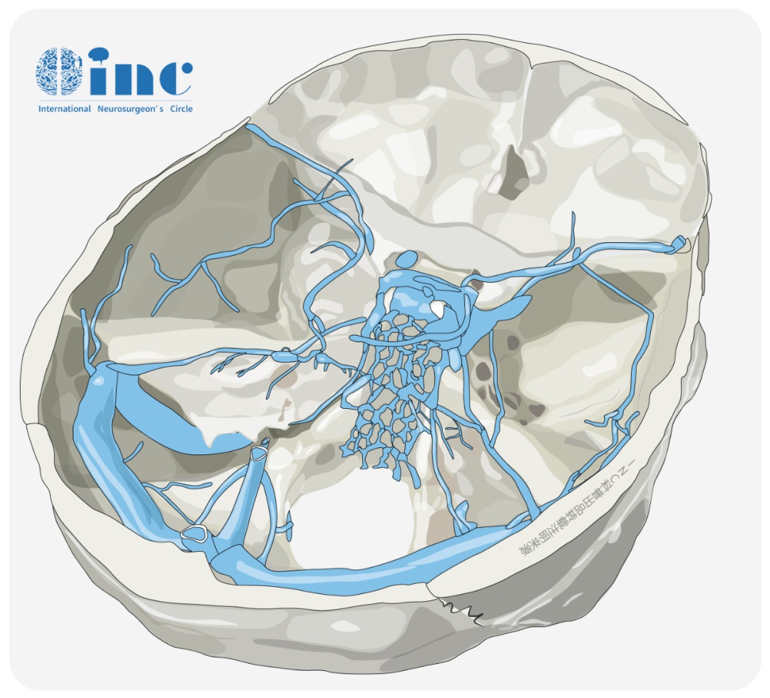 枕骨大孔区脑膜瘤