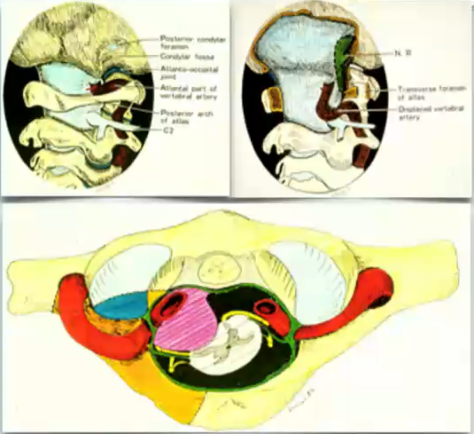 巴特朗菲教授及其导师Seeger教授共同绘制，从背外侧、枕下、经髁入路到下斜坡和颅颈交界处的前部。图自Neurosurgery 29：815-8211991