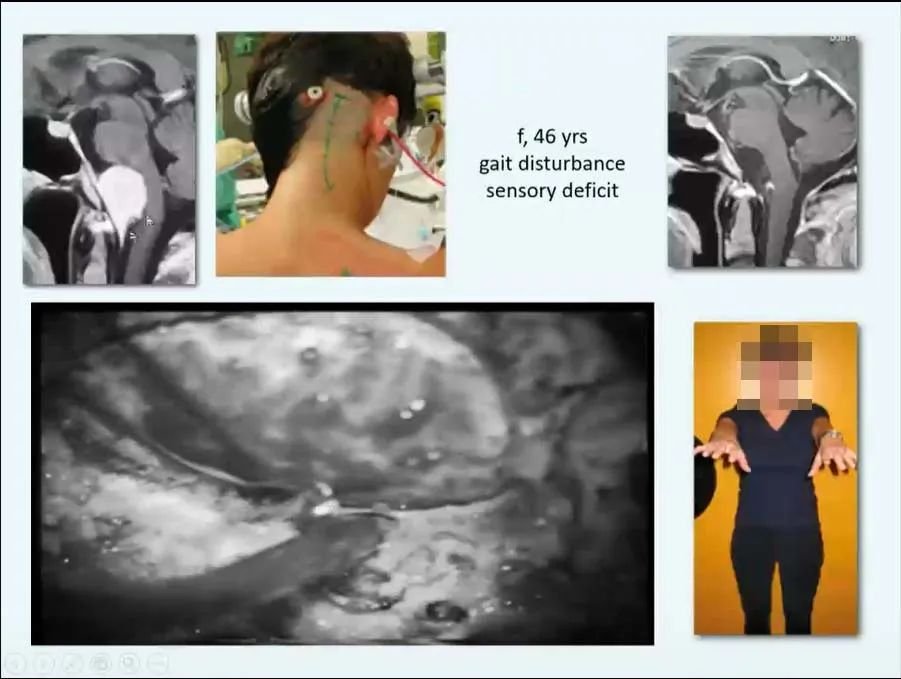 INC巴教授枕骨大孔区脑膜瘤精彩案例