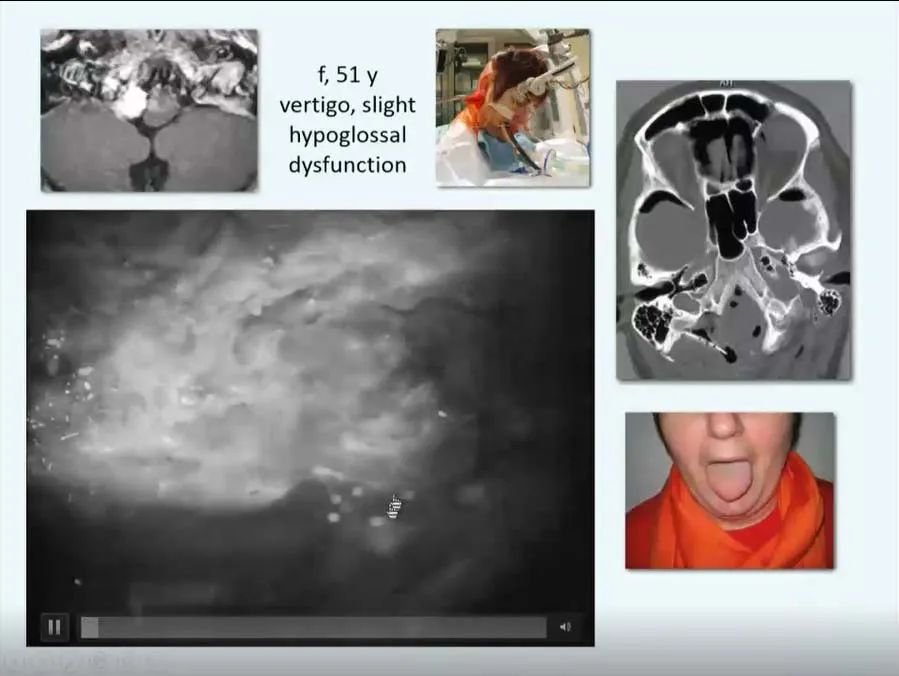 INC巴教授枕骨大孔区脑膜瘤精彩案例