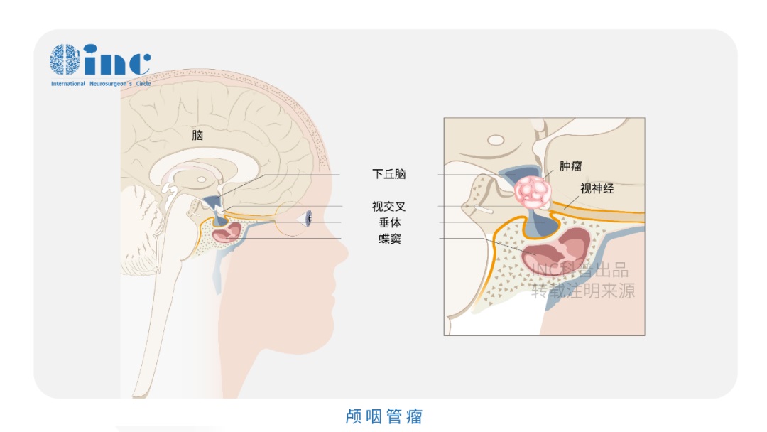 颅咽管瘤可怕吗？INC国际教授实例交流——了解它，不再恐惧它