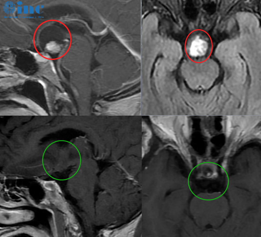 李奶奶的术前术后MRI对比，红色为术前肿瘤位置，绿色为术后切除效果