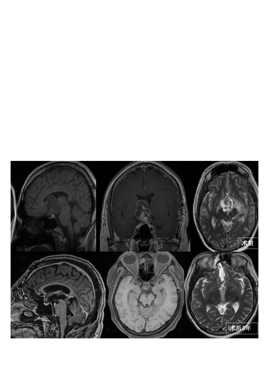 30多岁男性颅咽管瘤全切术后3年没有复发