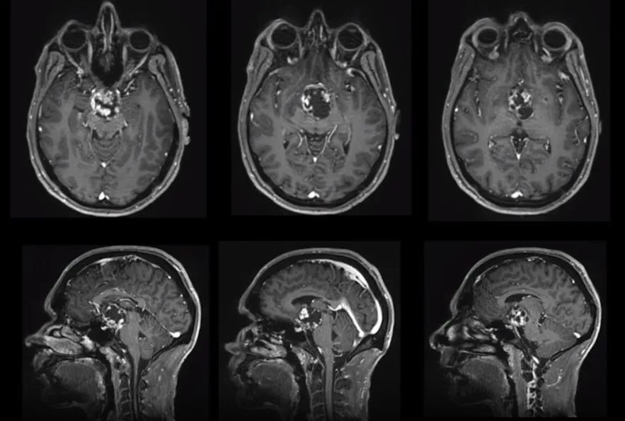 35岁男性颅咽管瘤视盲、认知下降
