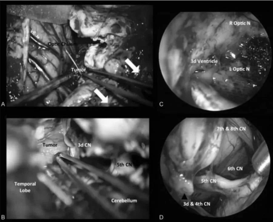 术中图像：（A）在经后岩骨入路时，横窦-乙状窦连接处的后部移位，为颞叶与后颅窝之间的手术通道（白色箭头）。（B）脚间池蛛网膜的初步解剖分离，肿瘤的暴露。内窥镜辅助可以对手术床进行详细检查（C），以便更好地了解周围的神经血管解剖结构（D）。CN，颅神经；L视神经N，左视神经；R视神经N，右视神经。