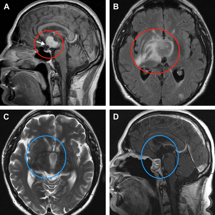 鞍上增强MRI显示，肿瘤延伸至第三脑室，有实性成分(a)。视神经交叉向前移位(箭头)。垂体和蝶鞍似乎正常。由于T2病灶周围水肿和反转恢复图像液体衰减并右侧基底神经节外侧延伸，怀疑下丘脑侵犯(B)。施罗德教授在内镜下行全切术，包括已被肿瘤浸润破坏的部分垂体柄。术后2年MRI未见肿瘤复发(C,D)。水肿完全消退(C)。图像(D)也显示鼻中隔皮瓣重建颅底。