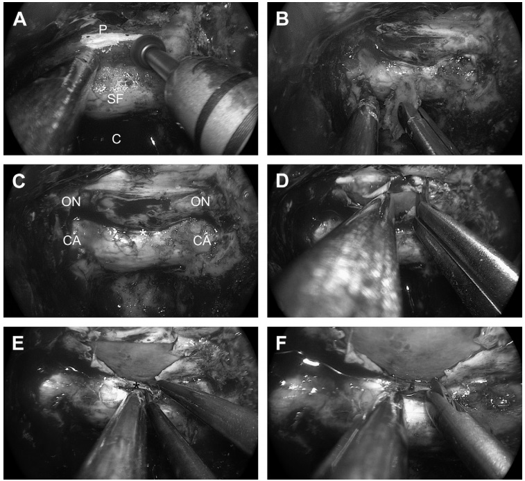 图15为打开蝶骨的阶段。(A)蝶鞍底(SF)和蝶面(P)在蝶腔内的蛋壳样钻孔。(B)去除薄骨层。(C)全骨切除后显露硬脑膜的全景图，并标记视神经(ON)、颈动脉(CA)和海绵窦内上方(SIS[星号])的位置。(D)鞍上间隙硬脑膜开口。(E)海绵窦内上方凝固。(F)海绵窦内上方截面。