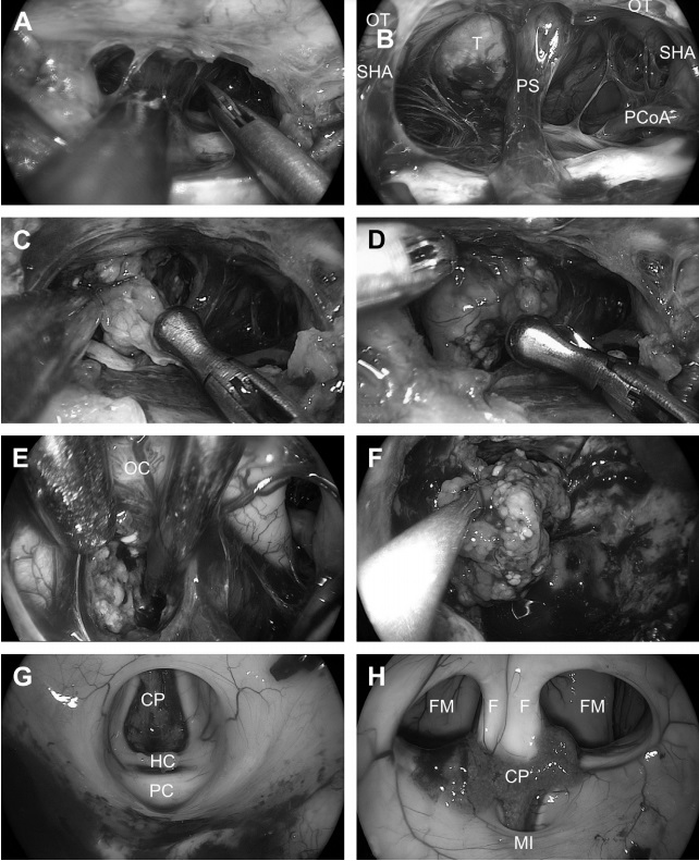 图16为硬膜内操作阶段。(A)锐性分离蛛网膜。(B)暴露鞍膈上区。可见垂体柄(PS)、后交通动脉(PCoA)、垂体上动脉(SHA)、视神经(OT)和肿瘤(T)。(C)切除肿瘤。双手用抓钳和解剖钳进行囊外剥离。垂体柄向左侧偏。(E)切换到30°内窥镜顺利实现交叉后肿瘤去体积(视交叉[OC])(F)将一大块肿瘤从三脑室移至蝶骨腔。(G)完全切除肿瘤后然后检查三脑室背侧部分(脉络膜丛[CP]，缰连合[HC]，后连合[PC])。(H)使用45°内窥镜检查三脑室前部(脉络丛(CP),穹窿[F],门室孔(FM)和丘脑间粘合(MI))。