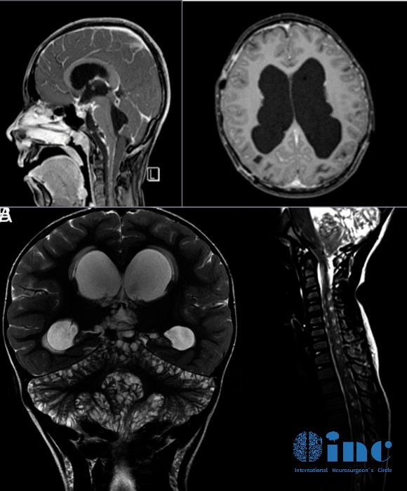 ​8岁男孩罹患少见脑瘤
