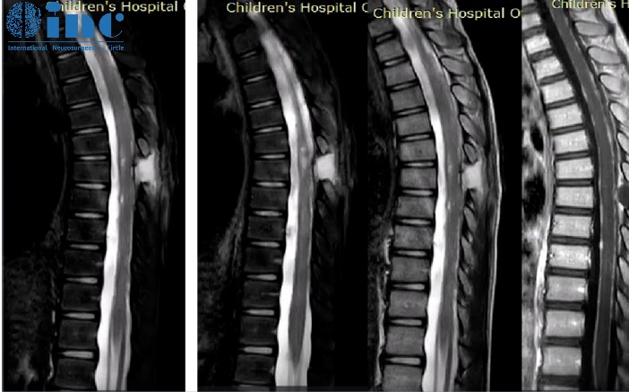 ​8岁男孩罹患少见脑瘤