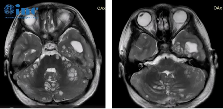 ​8岁男孩罹患少见脑瘤