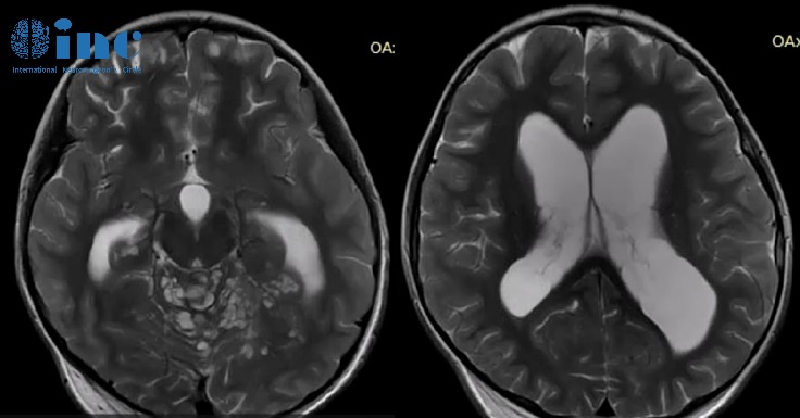 ​8岁男孩罹患少见脑瘤
