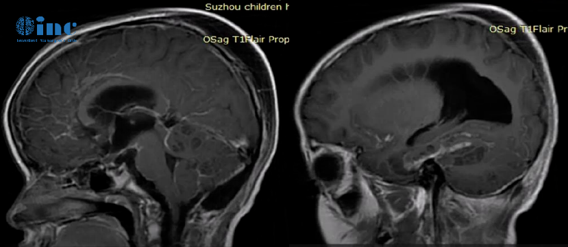 ​8岁男孩罹患罕见脑瘤