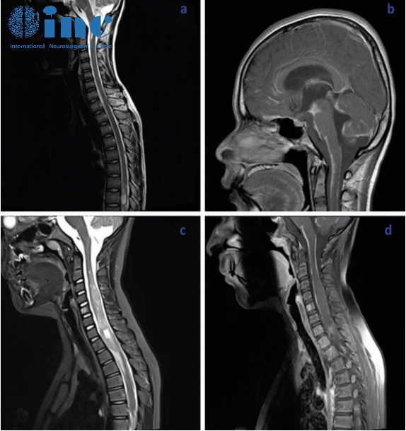 ​8岁男孩罹患少见脑瘤