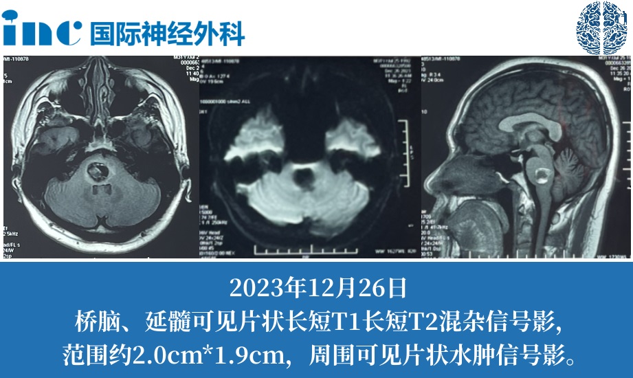 脑干海绵状血管瘤案例：家中“顶梁柱”脑干出血10多天竟无法行走！一场国际疑难手术后他怎么样了