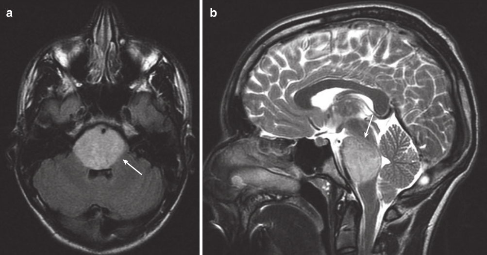 一名14岁男孩的MRI扫描，他有短暂的复视、共济失调和左侧面瘫。(a)轴向FLAIR MRI显示高信号占据整个脑桥（箭头）。(b)矢状T2 MRI显示DIPG使脑桥范围受累（箭头）