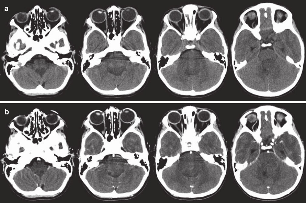一名12岁男孩背侧外生脑干胶质瘤的CT扫描，有5个月的病史，逐渐加重的肢体笨拙、共济失调和复视。(a)无对比的轴位CT扫描显示填充第四脑室的轻微低密度病变。(b)对比剂给药后，病灶呈斑片状、不均匀强化。背侧脑干病变边界没有得到很好地显示