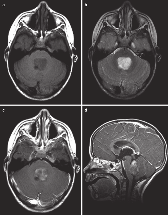 图5：背侧外生脑干胶质瘤的MRI扫描。(a)轴位T1 MRI显示病灶与第四脑室底直接相对。(b)轴位T2 MRI显示第四脑室中的高信号病变。(c)轴位T1 MRI对比显示病变有些斑片状强化。(d)矢状位T1 MRI对比CT显示肿瘤与第四脑室底部的关系，分辨率高于CT