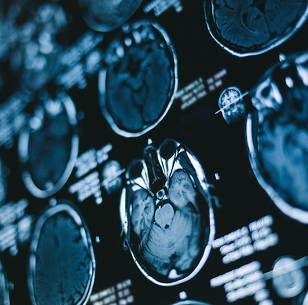 (a)后颅窝病变的标准中线入路，适用于背侧外生型脑干胶质瘤。患者俯卧位固定（上图），进行小的局部中线剃发。(b)枕部中线暴露进行时要记住两侧横窦的定位。如图所示进行开颅手术。四个钻孔用于准备用于去除颅骨的开颅器。小心识别枕骨大孔的唇部，以免在使用开颅器时造成硬脑膜撕裂。(c)硬脑膜以Y形方式切开并反折，其边缘用钉缝线固定。(d)小脑半球被轻轻，暴露四脑室。显微镜用于切除肿瘤，注意不要在任何时候越过四脑室底部。或者，可以使用经髓帆入路进行肿瘤切除