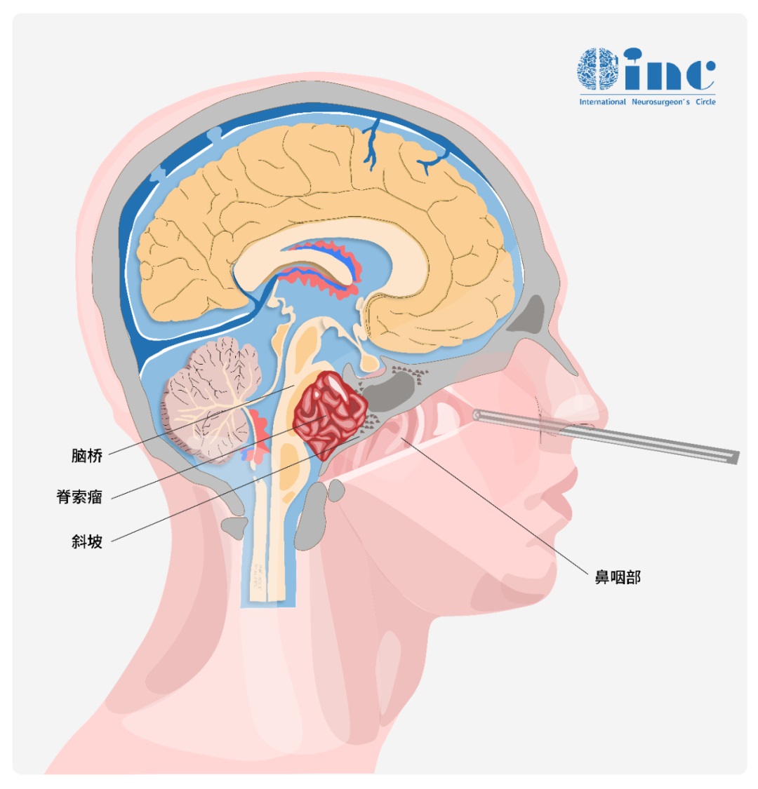 脊索瘤多次复发案例