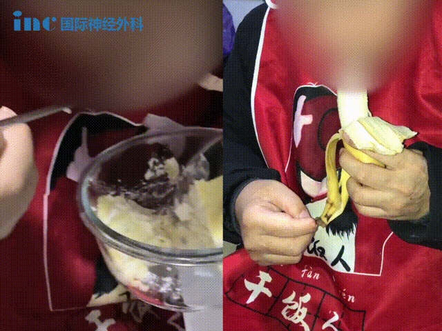 48岁男性较大脊索瘤5年内4次复发3次手术