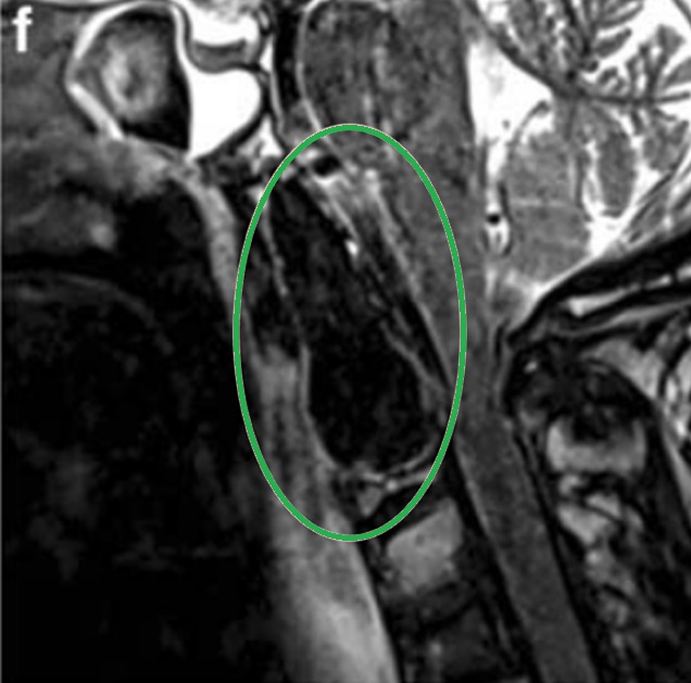 F手术顺利，术后MRI显示肿瘤完全除，患者在一开始手术后10天接受了枕颈固定，没有任何并发症。