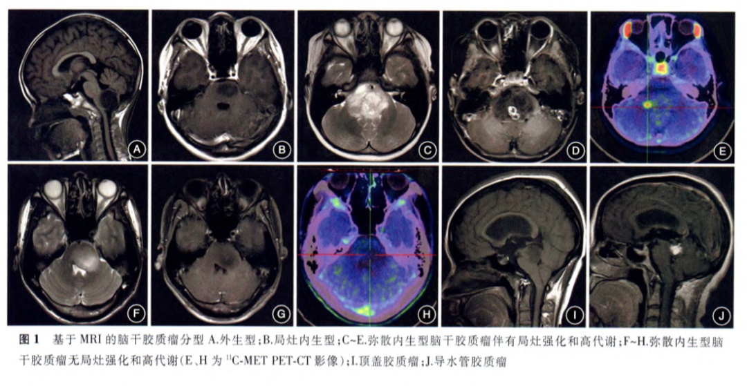图1.基于MRI的脑干胶质瘤分型A.外生型；B.局灶内生型；C-E.弥散内生型脑干胶质瘤伴有局灶强化和高代谢；F-H.弥散内生型脑干胶质瘤无局灶强化和高代谢（C、H为11C-METPET-CT影像）；I.顶盖胶质瘤；J.导水管胶质瘤.不同型治疗或预后会有差别。图自脑干胶质瘤咨询共识