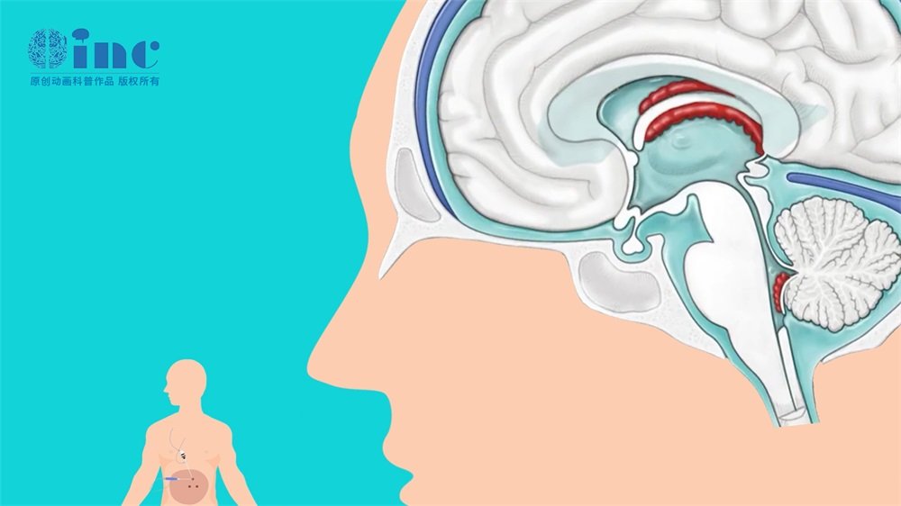 成人星形细胞瘤