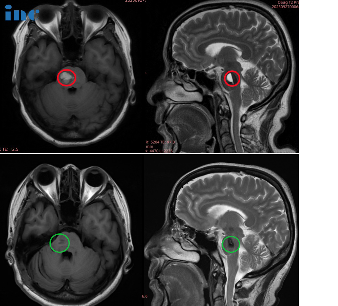金女士术后3个月影像对比