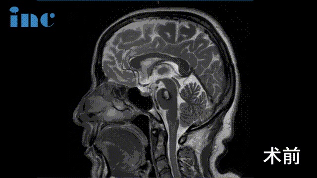 影像对比提示金女士的海绵状血管瘤增大，出血量逐渐增多