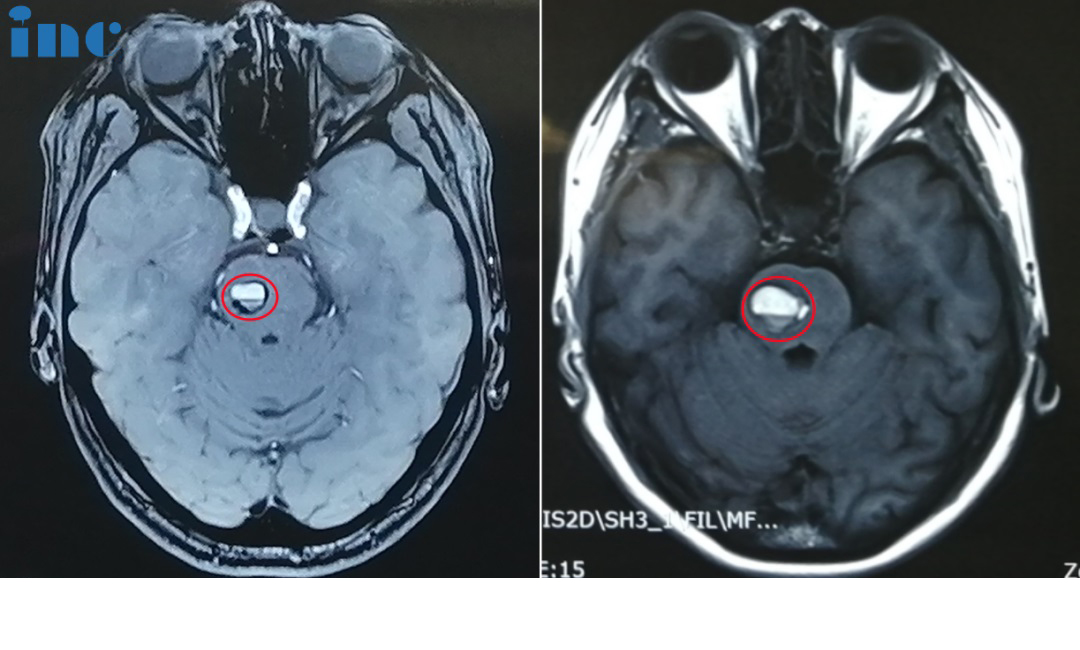影像对比提示金女士的海绵状血管瘤增大，出血量逐渐增多