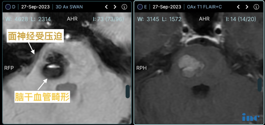 术前影像：面神经受压迫