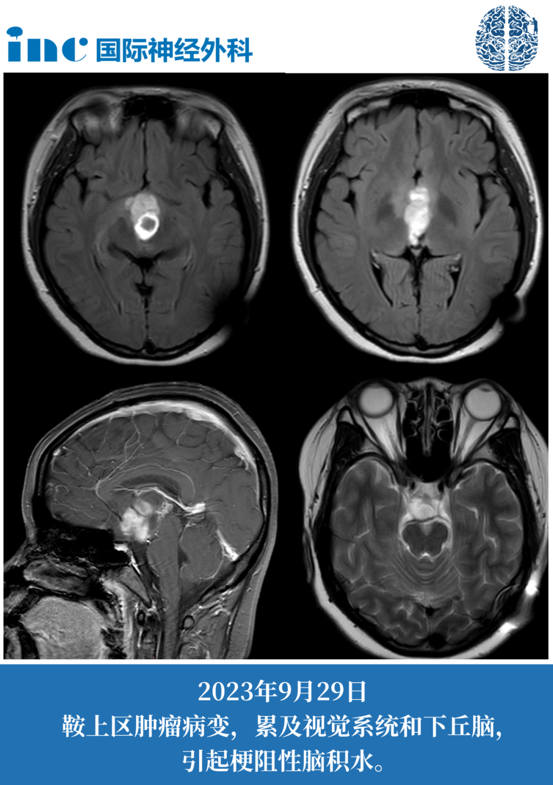 视神经-下丘脑区巨大胶质瘤案例