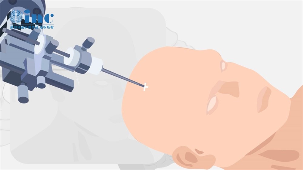 星形胶质母细胞瘤