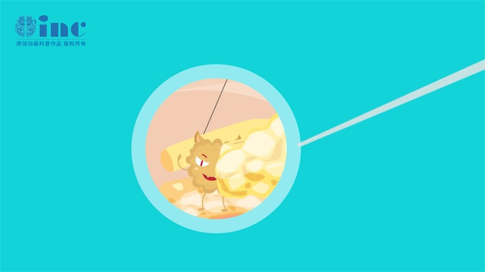 颈椎星形细胞瘤