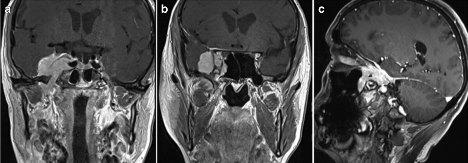 一名61岁女性出现V1（嗅神经）和V2感觉迟钝和感觉减退。MRI显示增强病灶以右侧海绵窦为中心，延伸至颞窝、SOF、FR、FO、PPF、ITF和SphS（图a-c）。