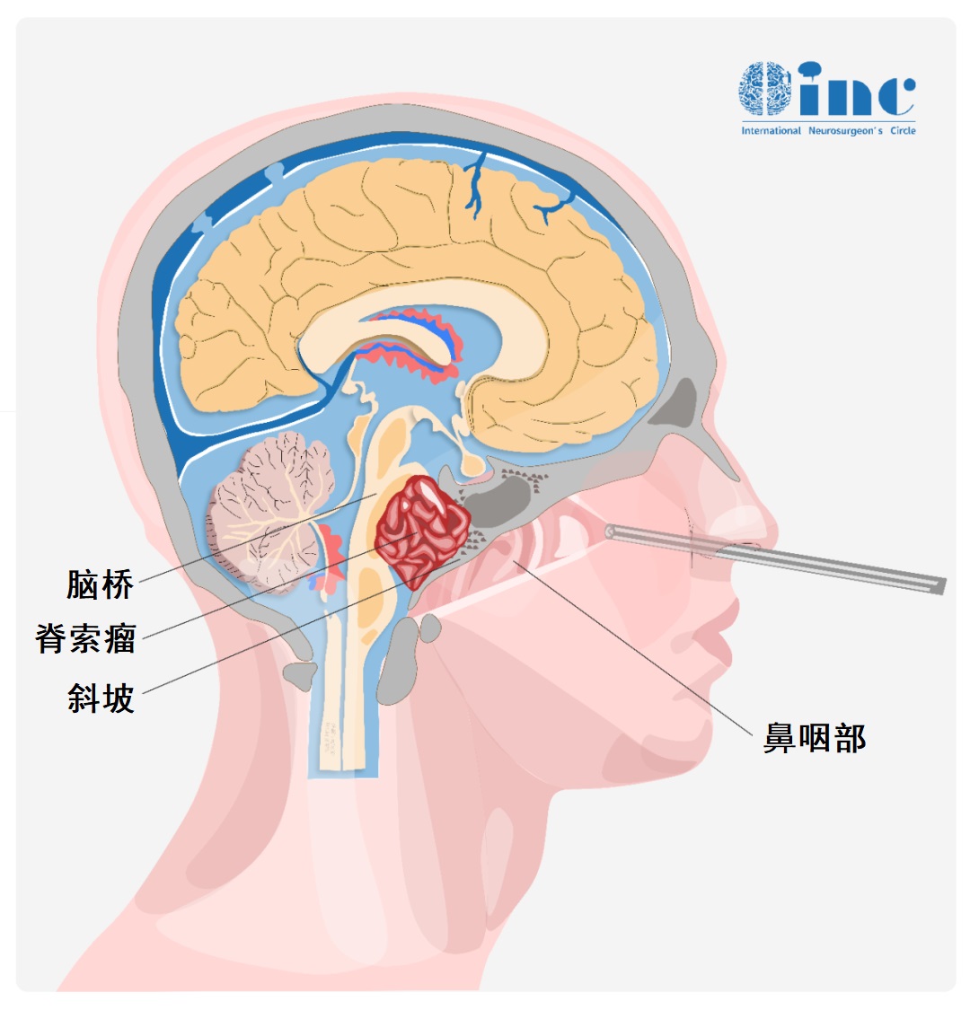 图示为内镜经鼻入路切除<a href='/bingzhong/jisuoliu/' target='_blank'><u>脊索瘤</u></a>