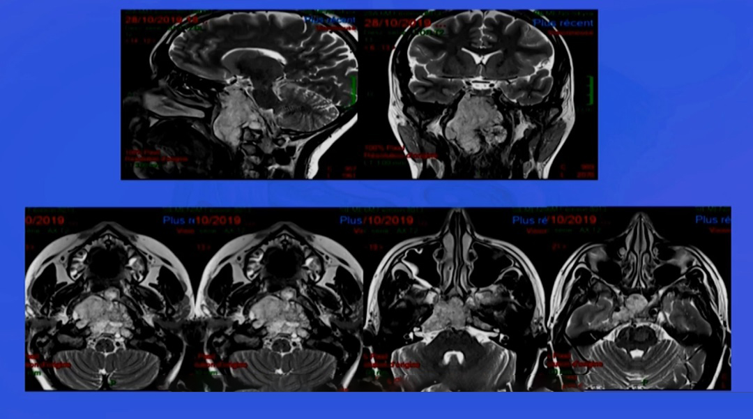 从鼻子切脑子里的肿瘤