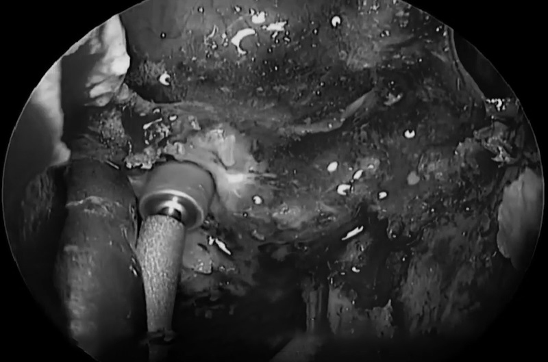 如果你有弯曲的仪器可以慢慢操作，因为脊索瘤是软的，这也是脊索瘤的特点之一。