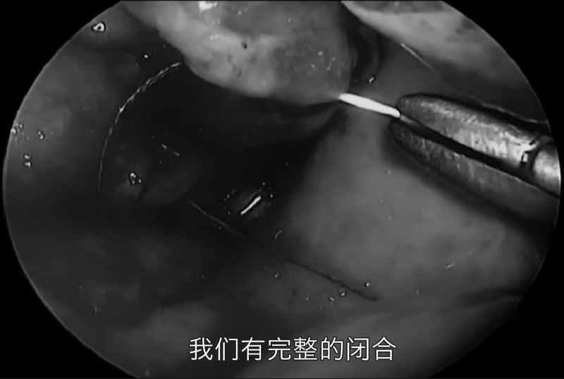 现在进行缝合，然后，缝合之前黏膜上的切口，达到完整的闭合。