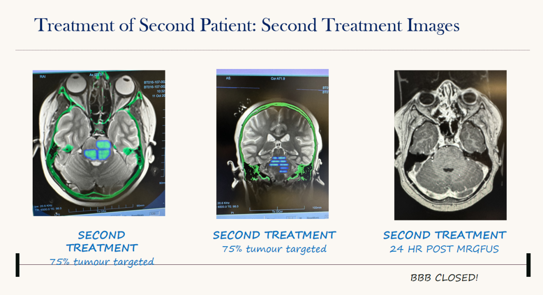 第二个病人在75%肿瘤靶向定位磁波刀治疗，左边MR图是脑干定位区域情况，最右的MR图显示未进行定位治疗的，右侧脑桥未见强化特点。