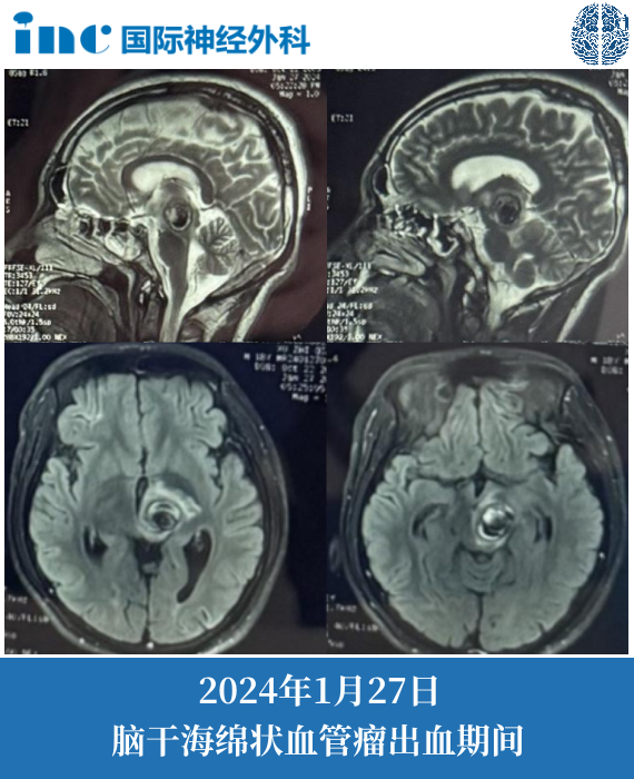 18岁男孩-脑干海绵状血管瘤