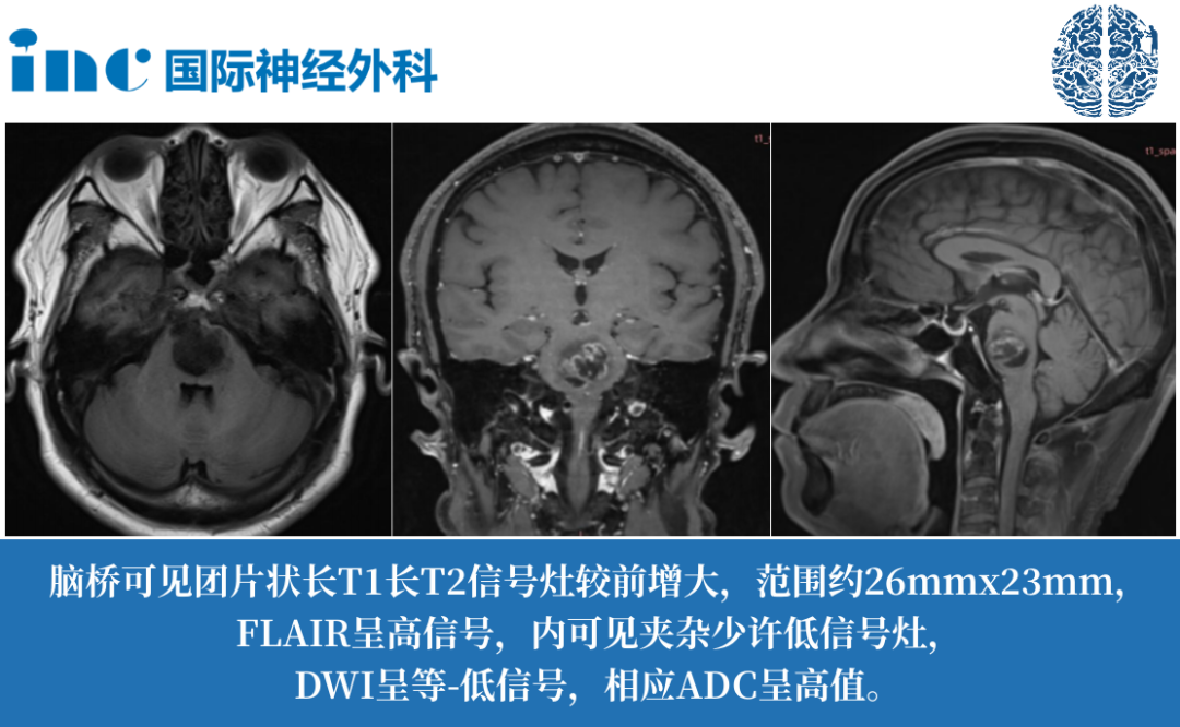 57岁男性-脑干胶质瘤