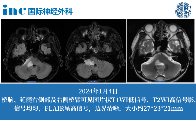 36岁男性-桥脑、延髓右侧及右侧桥臂占位