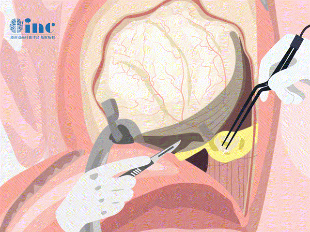 脑干教授全切延髓海绵状血管瘤“迄今为止较复杂、较深入的手术之一”